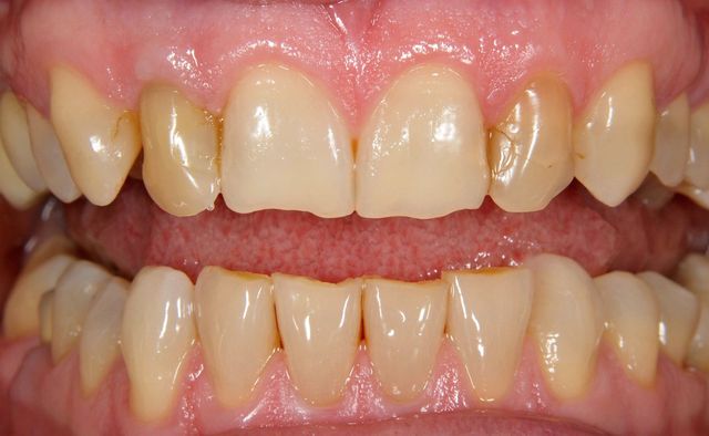 Smile Gallery - A2Z Dental - Before and After Photos